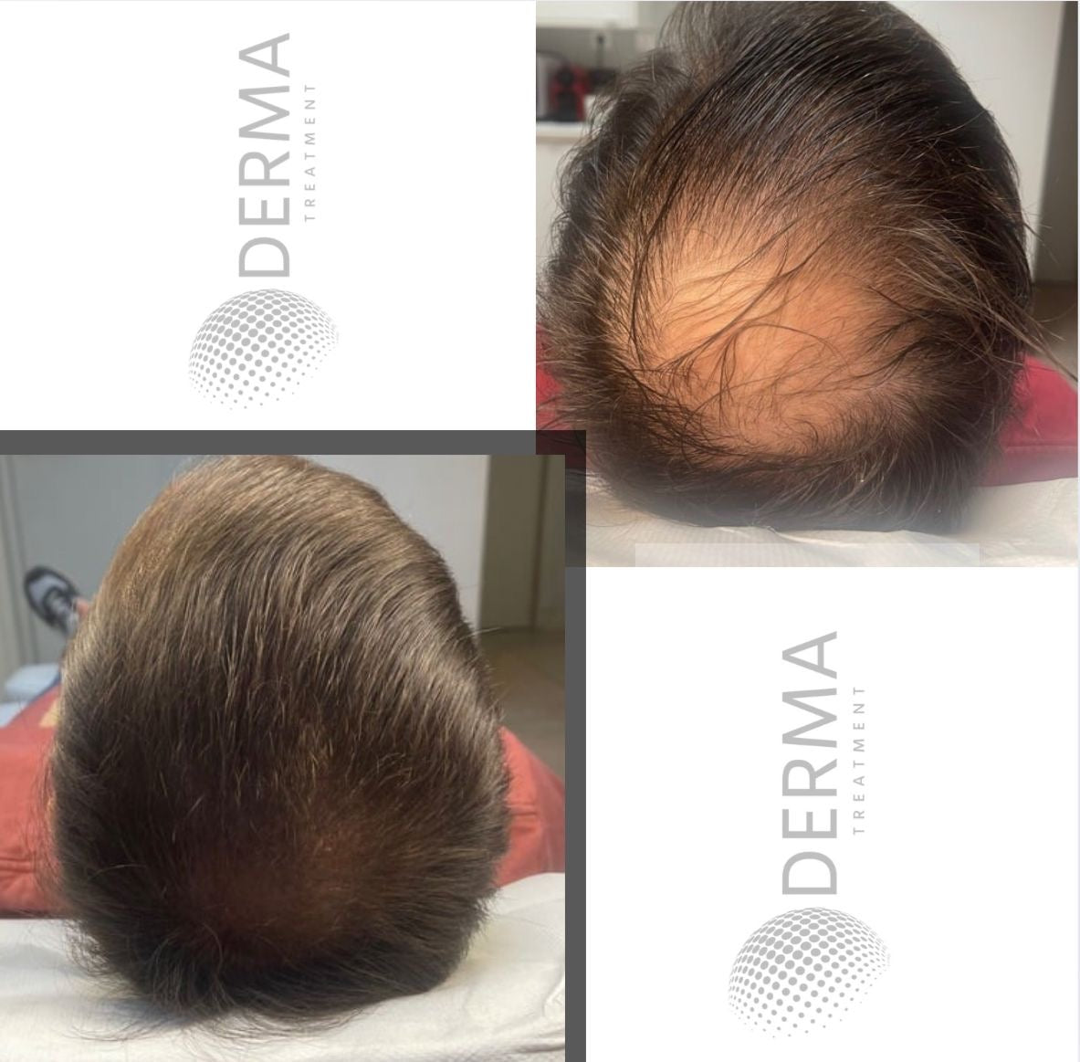 Résultat 05 de tricopigmentation capillaire