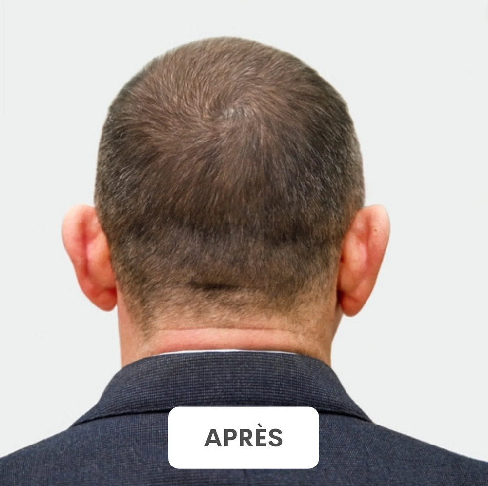 Résultat après