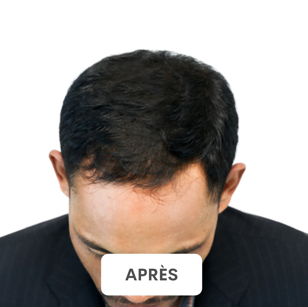 Résultat après