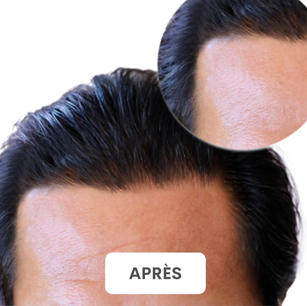 Résultat après