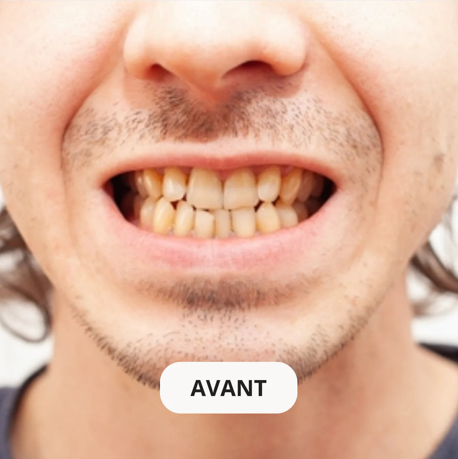 Avant éclaircissement dentaire