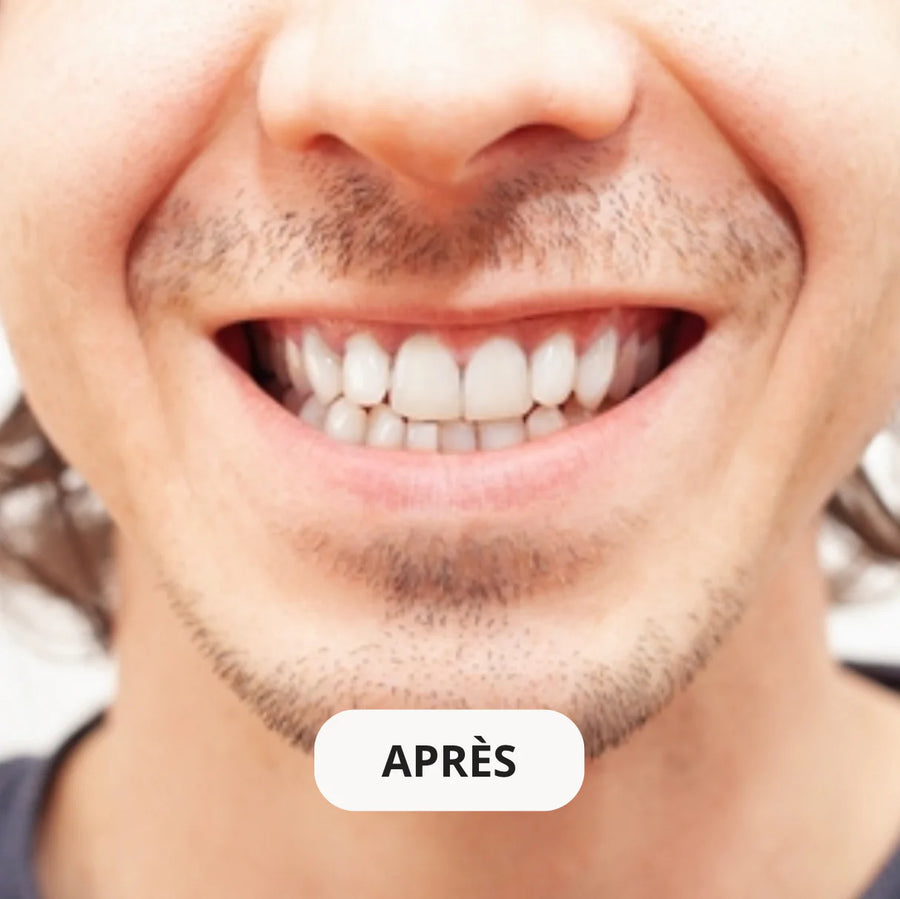 Après éclaircissement dentaire