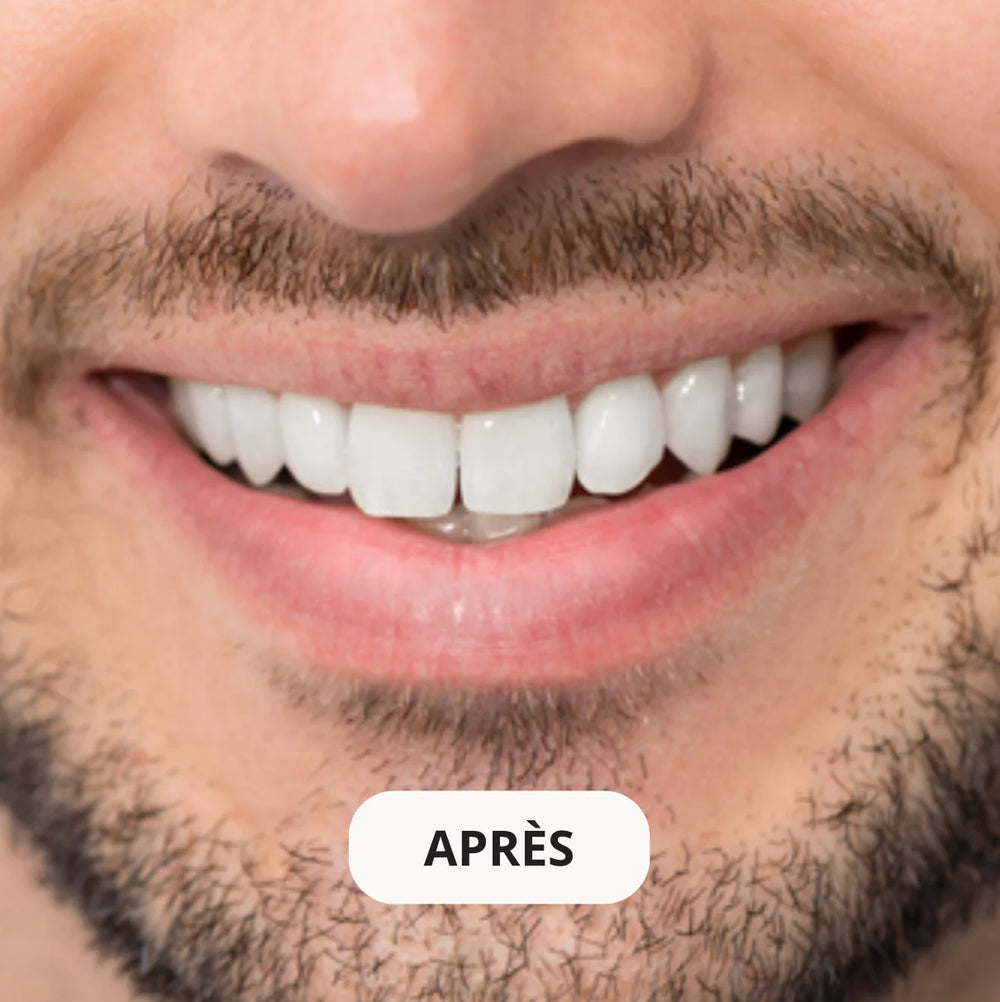 Résultat après