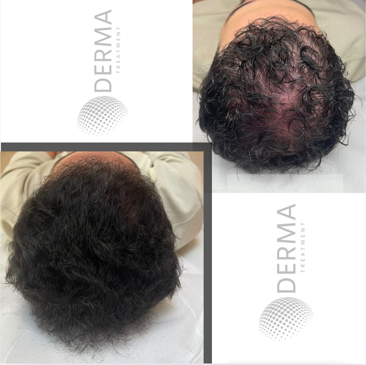 Résultat 03 de tricopigmentation capillaire