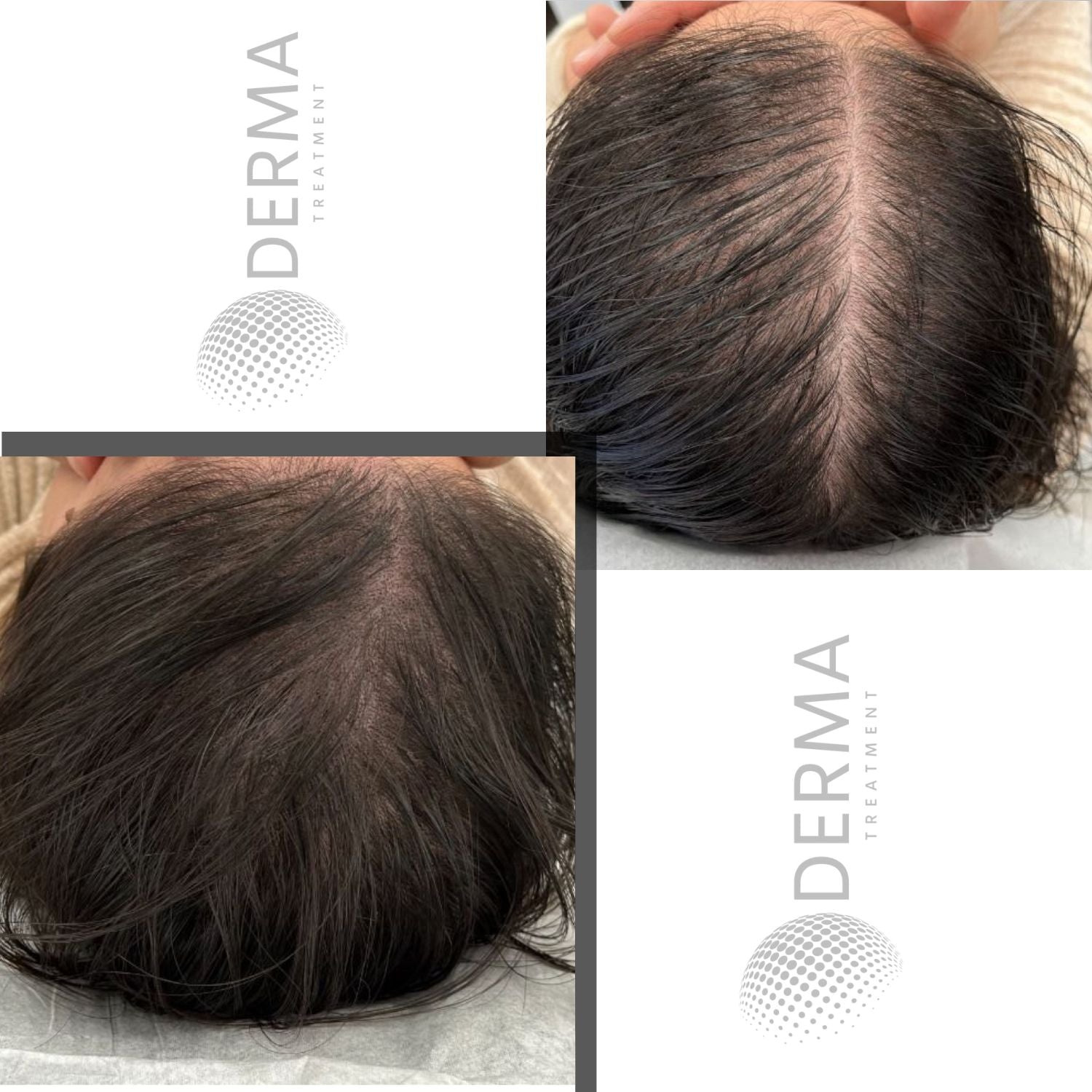 Résultat 10 de tricopigmentation capillaire