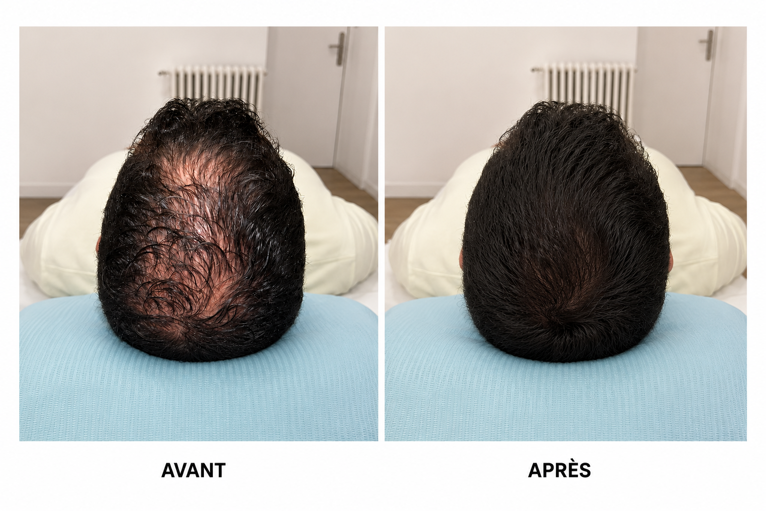 DERMA TREATMENT - TRICOPIGMENTATION MARSEILLE