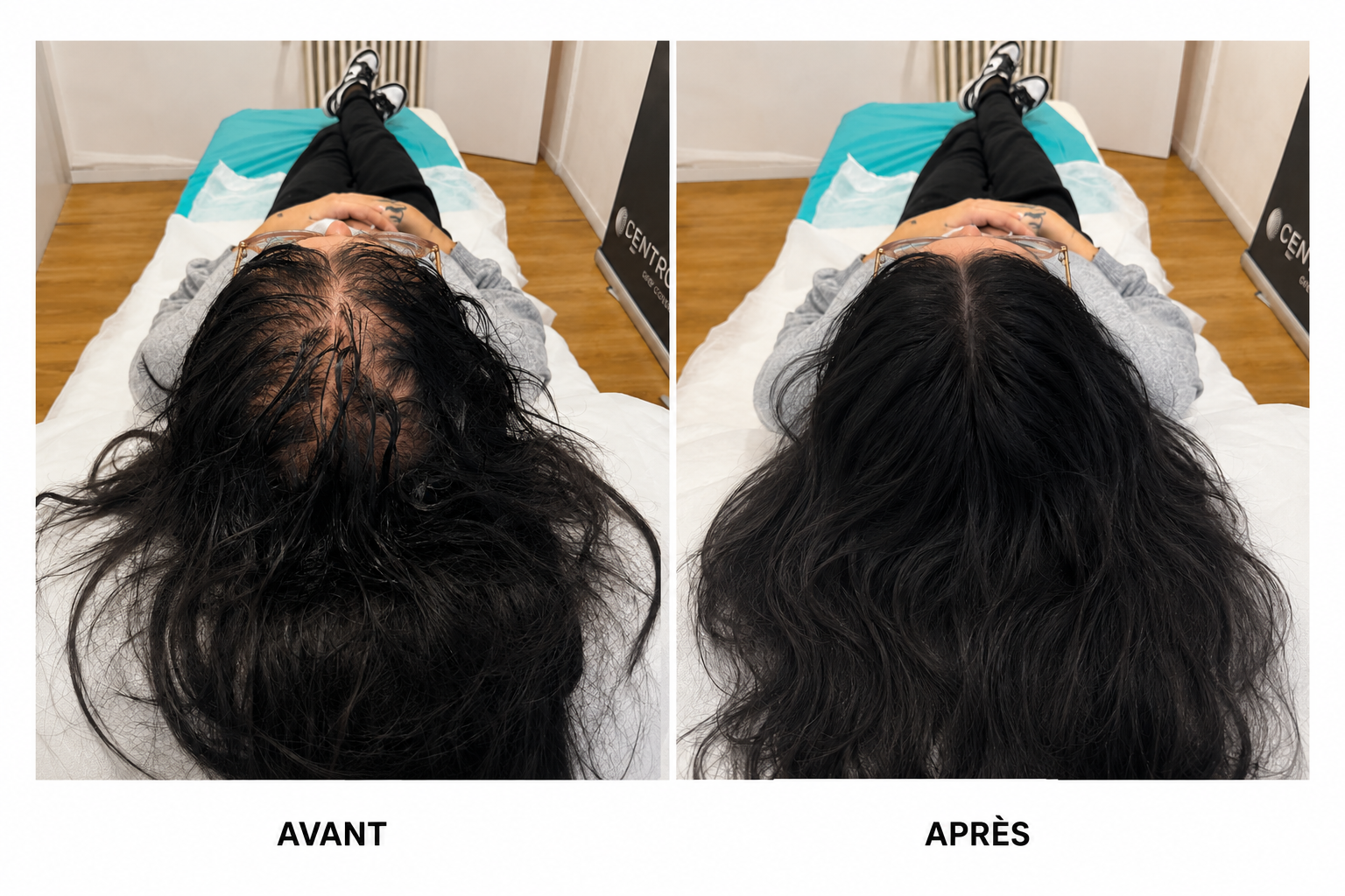 DERMA TREATMENT - TRICOPIGMENTATION MARSEILLE