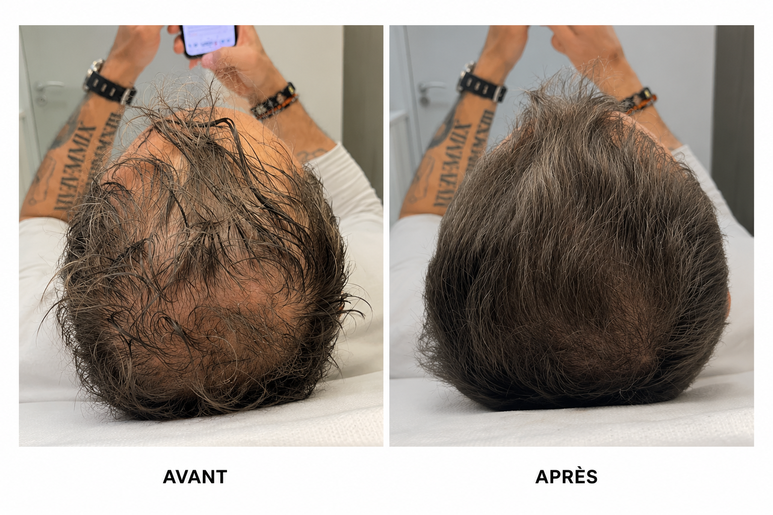 DERMA TREATMENT - TRICOPIGMENTATION MARSEILLE