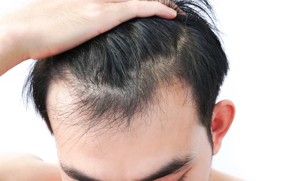 Cheveux clairsemés chez l'homme avant tricopigmentation à Marseille