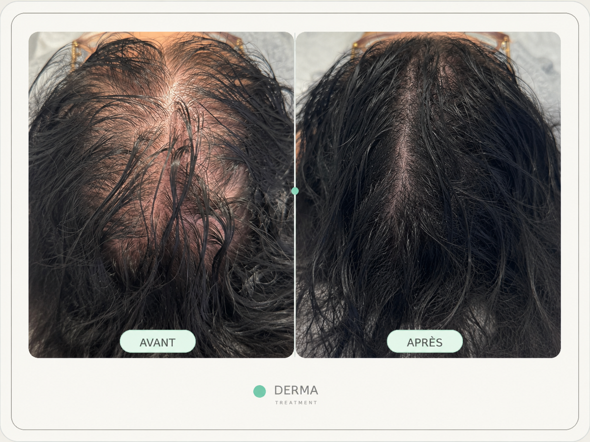 Avant après cheveux clairsemés femme