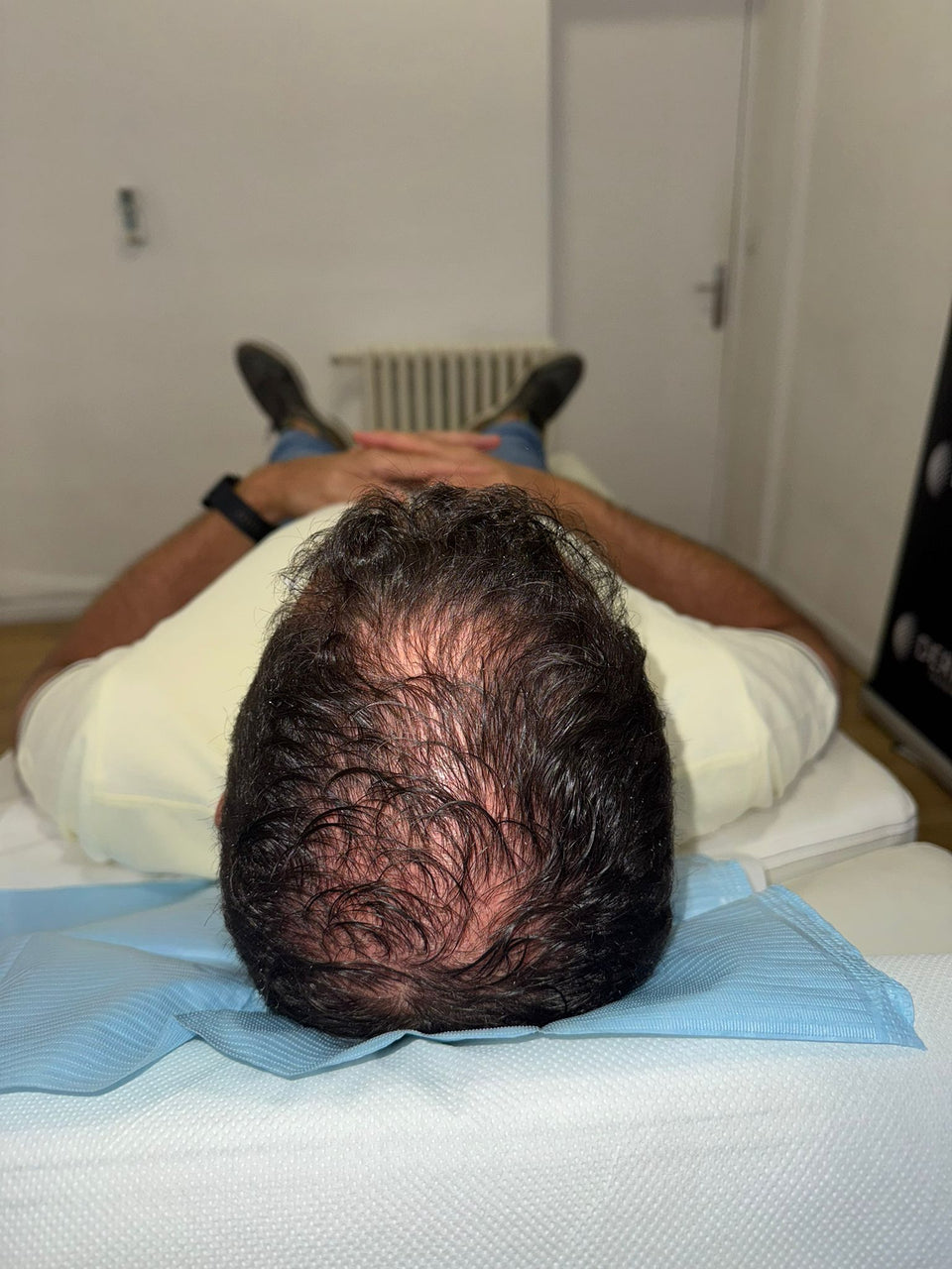 Avant densification : cuir chevelu visible au sommet de la tête entre les cheveux