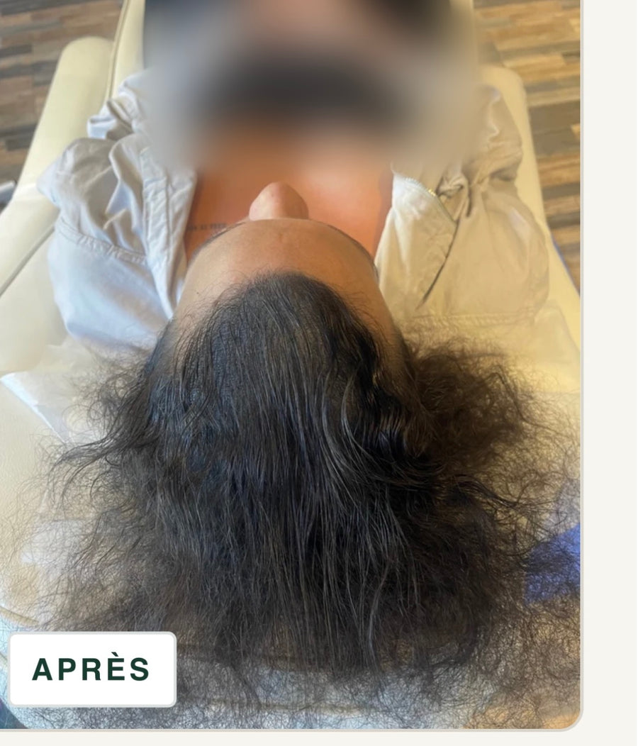 Après tricopigmentation capillaire — résultat 7