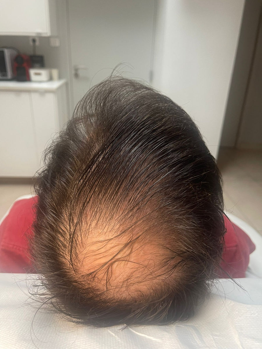 Avant tricopigmentation capillaire — résultat 1