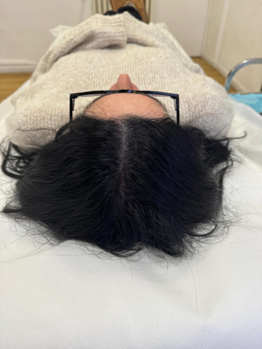 Après tricopigmentation capillaire — résultat 3