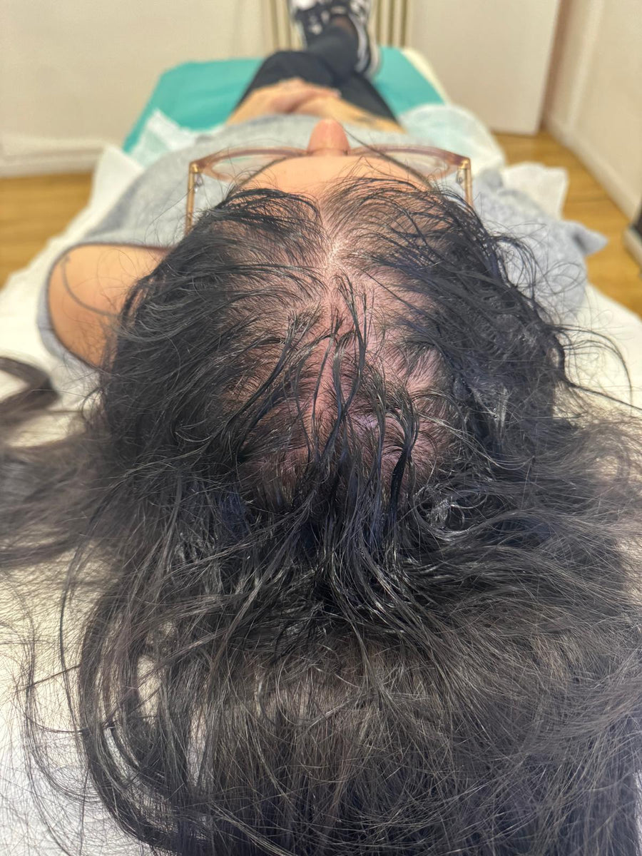 Avant tricopigmentation capillaire — résultat 3