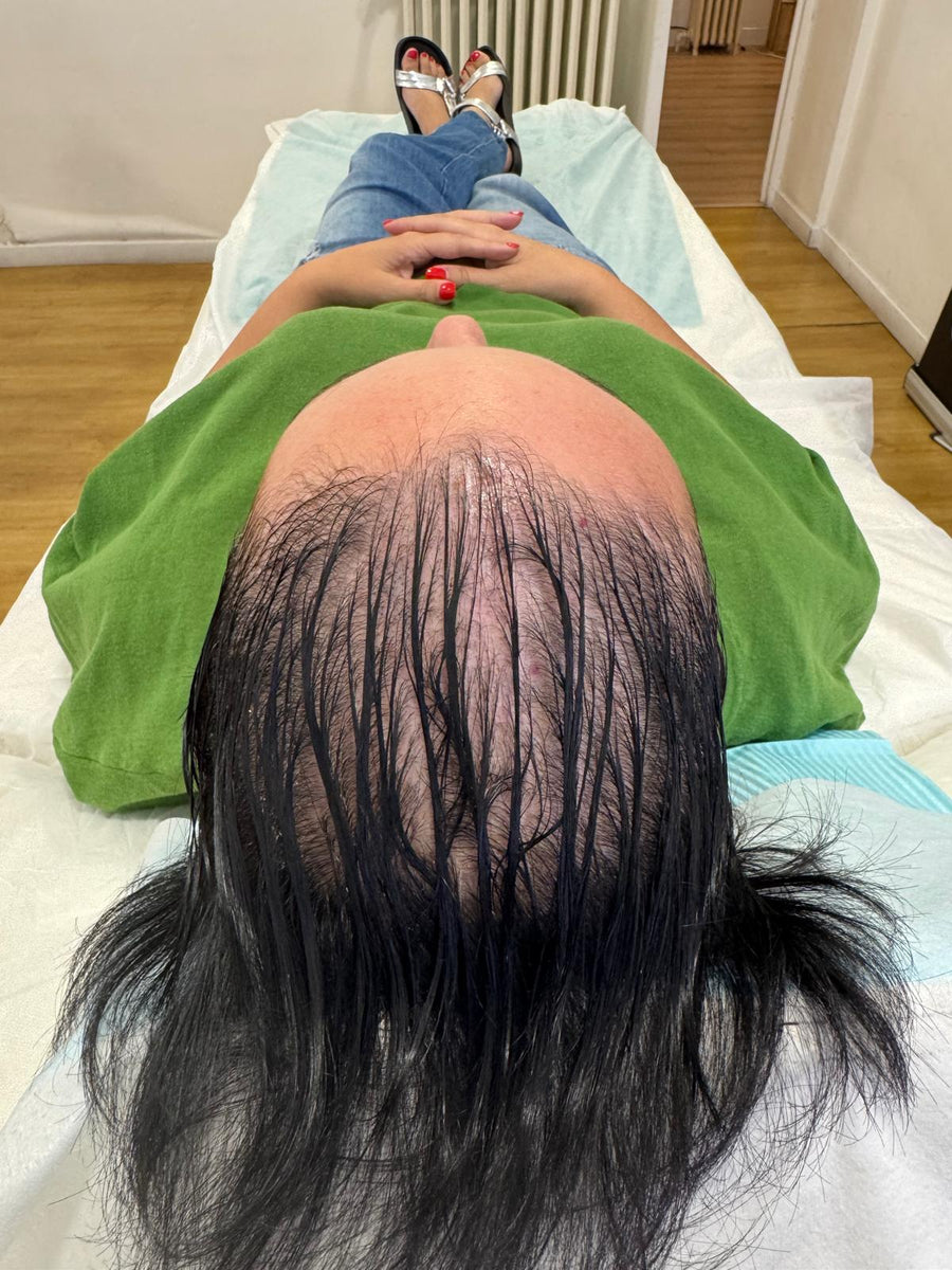 Après tricopigmentation capillaire — résultat 4