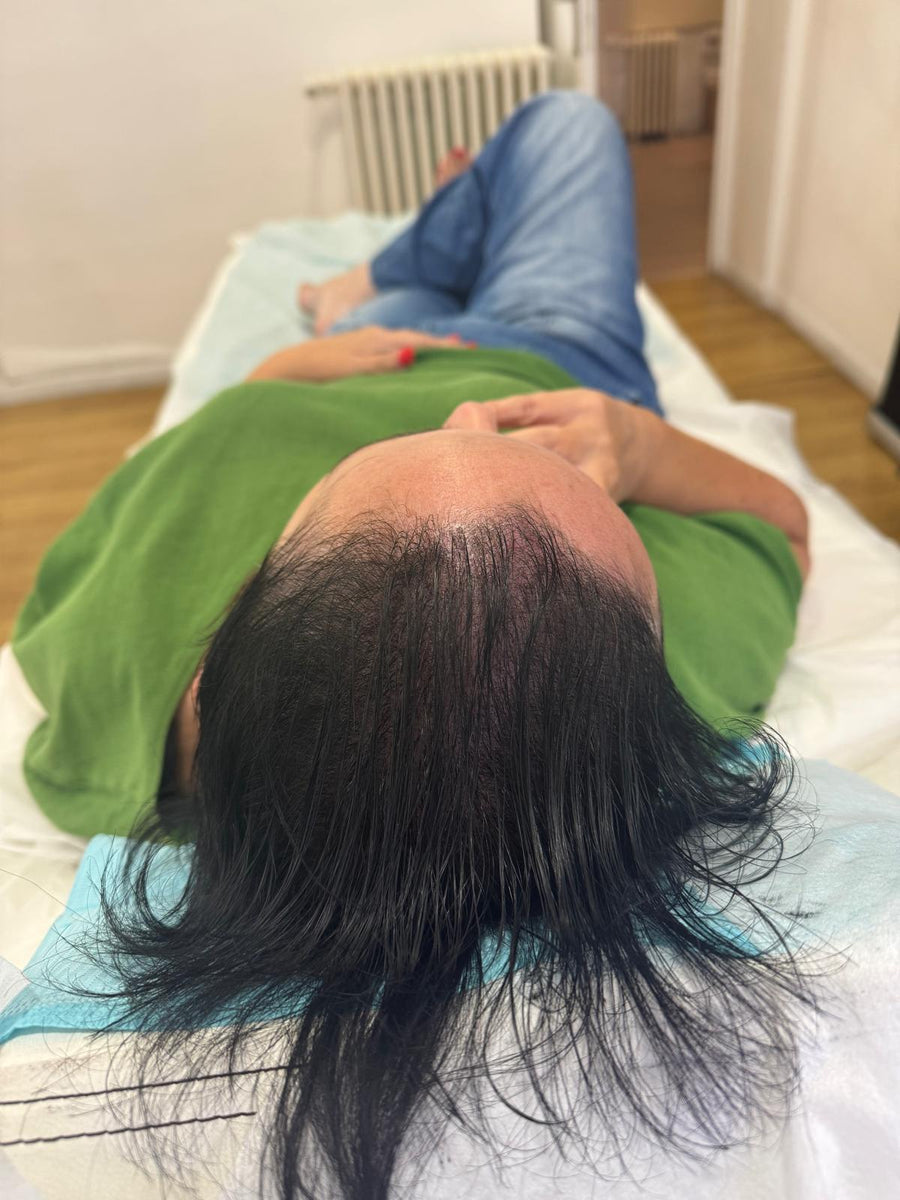 Avant tricopigmentation capillaire — résultat 4