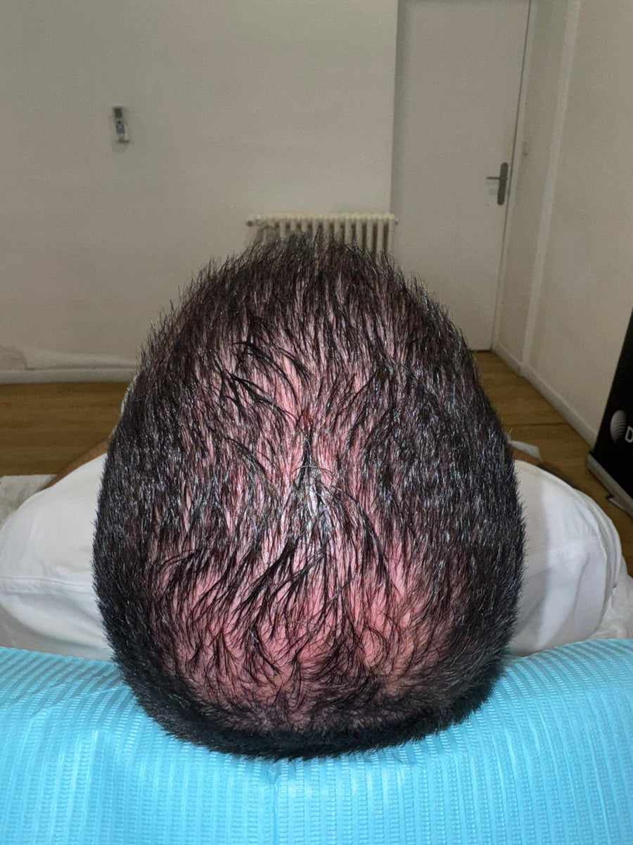 Avant tricopigmentation capillaire — résultat 5
