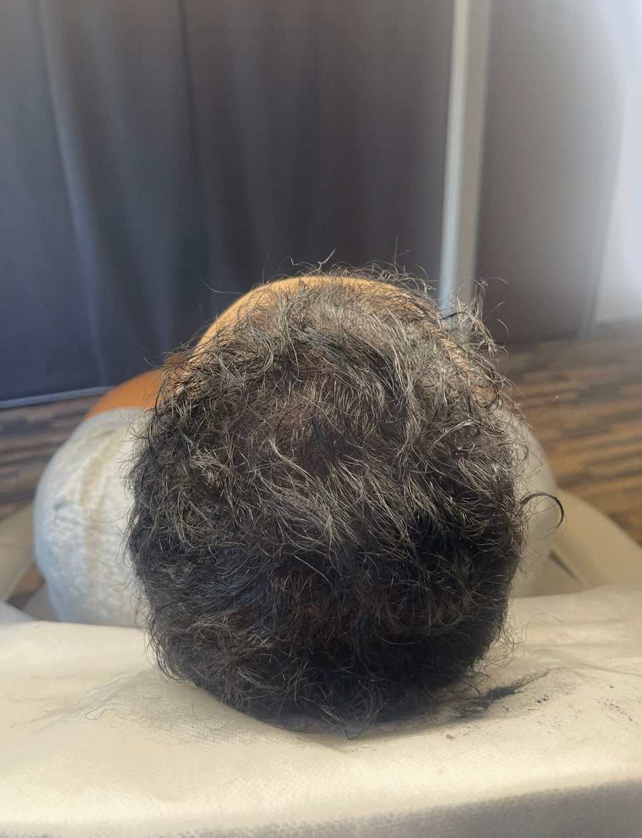 Après tricopigmentation capillaire — résultat 6
