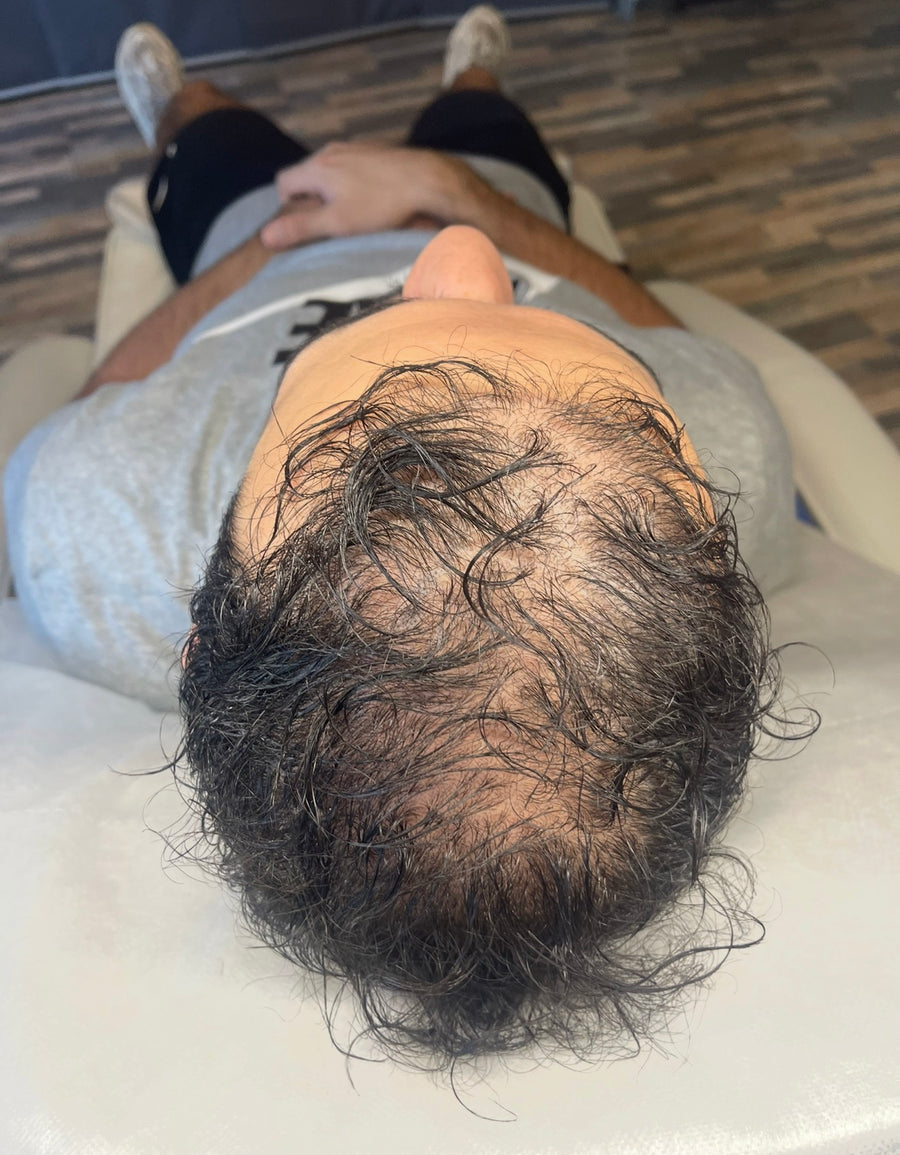 Avant tricopigmentation capillaire — résultat 6