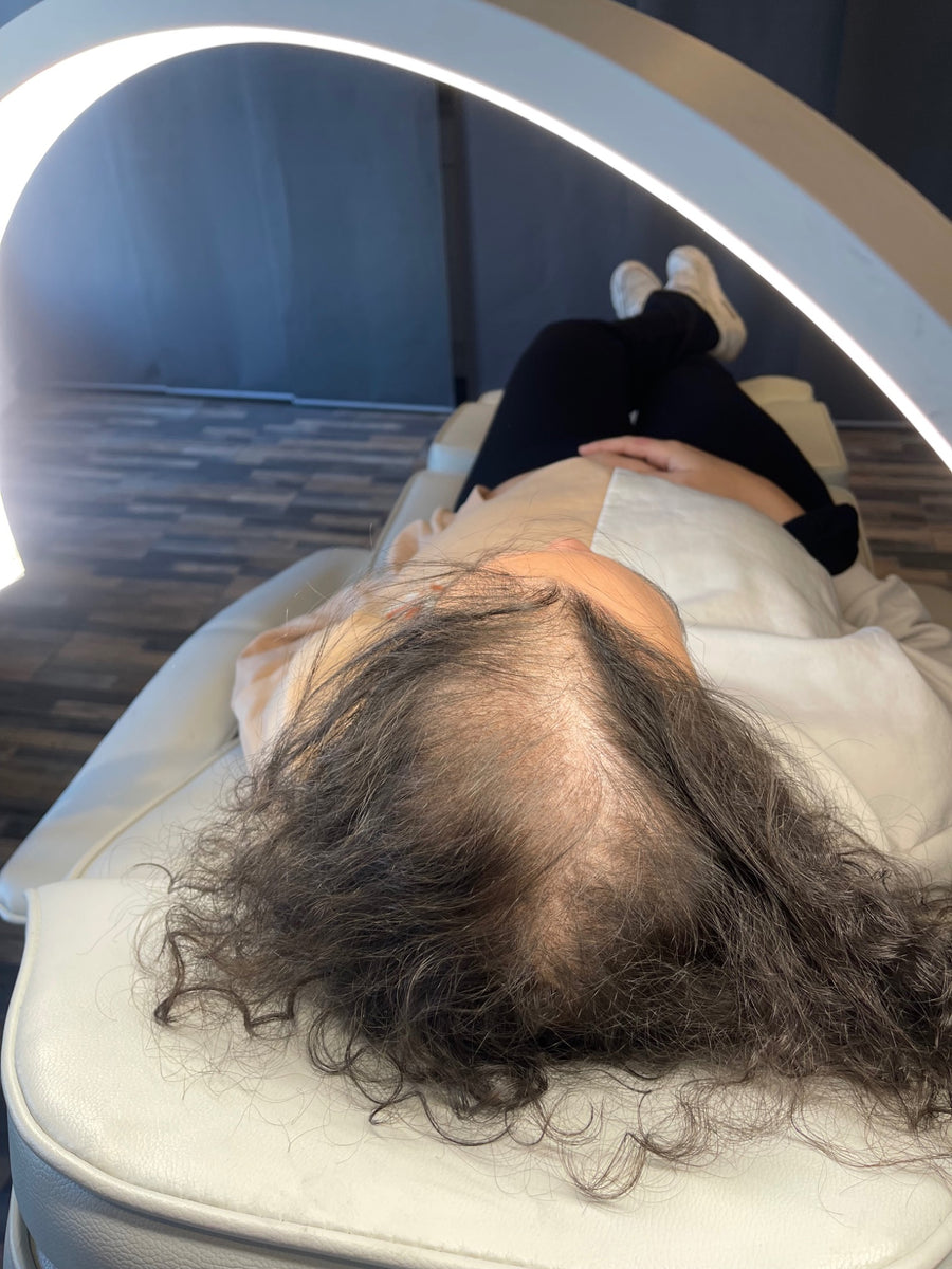 Avant tricopigmentation capillaire — résultat 7