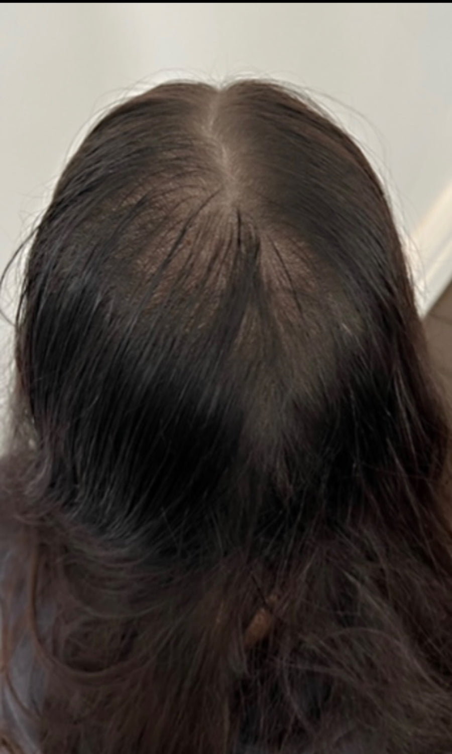 Après tricopigmentation capillaire — résultat 8