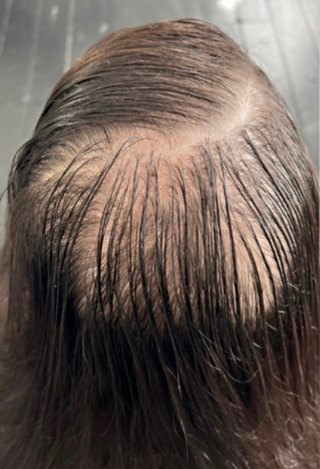 Avant tricopigmentation capillaire — résultat 8