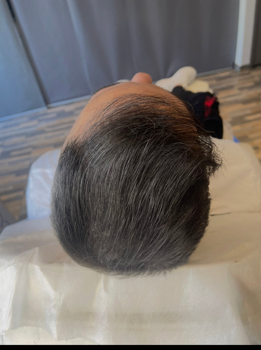 Après tricopigmentation capillaire — résultat 9