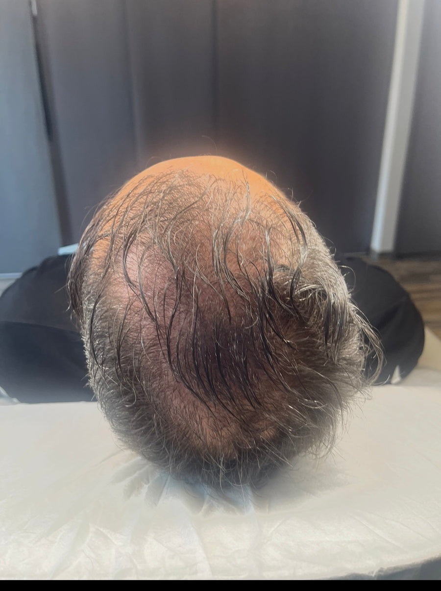 Avant tricopigmentation capillaire — résultat 9