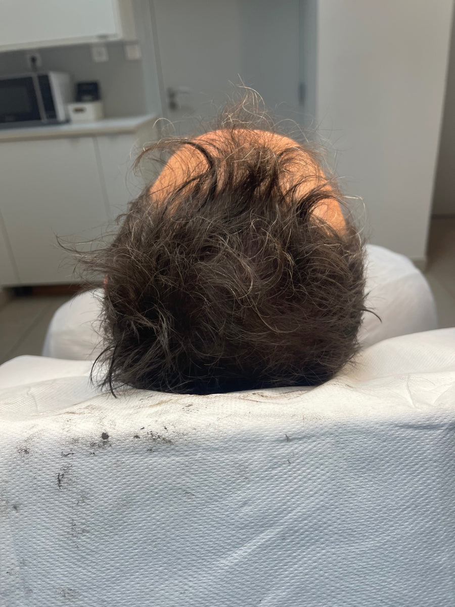 Après tricopigmentation capillaire — résultat 10