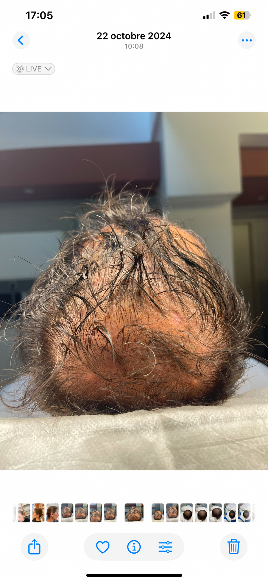 Avant tricopigmentation capillaire — résultat 10