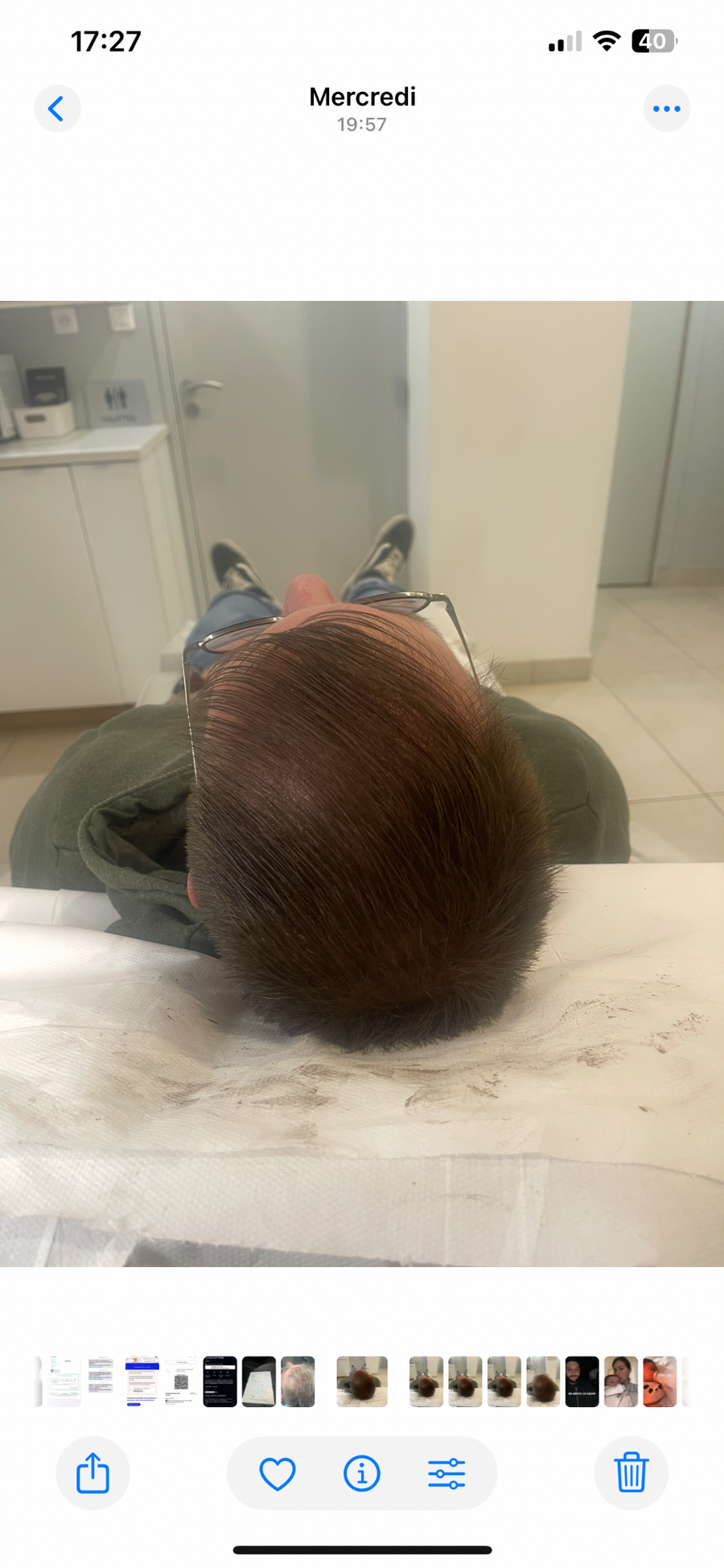 Après tricopigmentation capillaire — résultat 11
