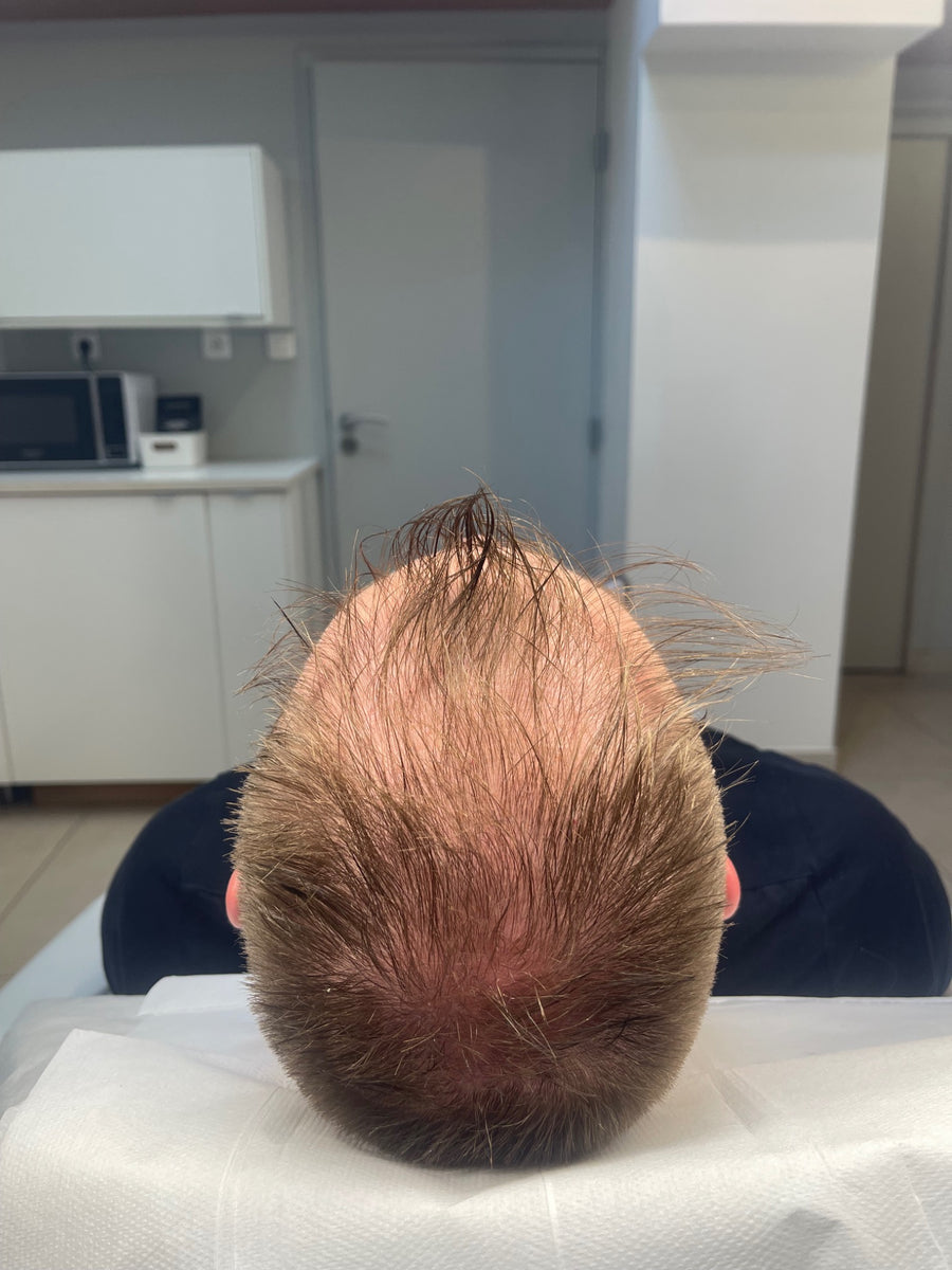 Avant tricopigmentation capillaire — résultat 11