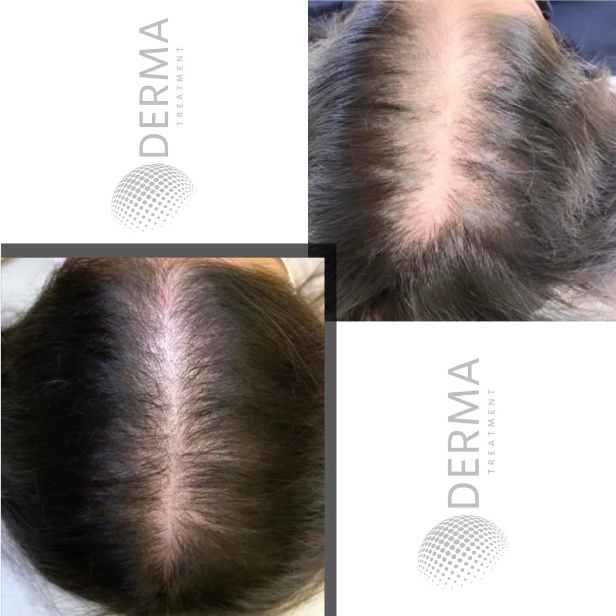 Avant la tricopigmentation : raie centrale clairsemée, cas client 14