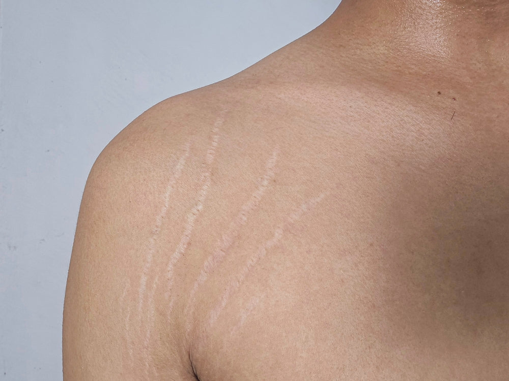Dermopigmentation réparatrice