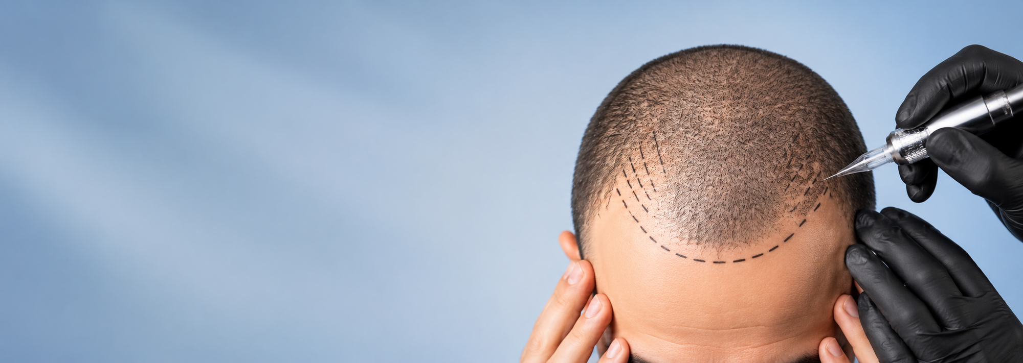 <h2><span style="color:#FFFFFF;">FORMATION DERMOPIGMENTATION CAPILLAIRE À MARSEILLE</span></h2>