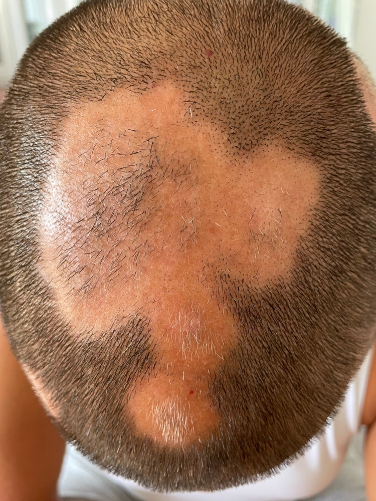 QU’EST-CE QUE LA PELADE CHEZ L’HOMME ?