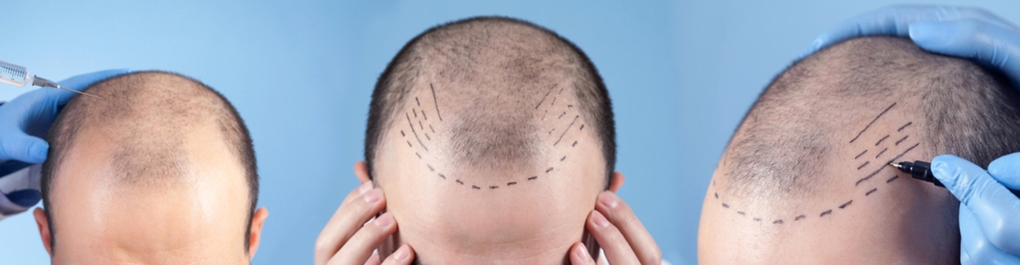 <h2><span style="color:#FFFFFF;">FORMATION DERMOPIGMENTATION CAPILLAIRE À MARSEILLE</span></h2>