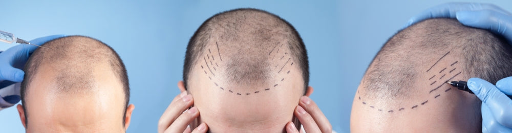 <h2><span style="color:#FFFFFF;">FORMATION HAIR NEEDLING À MARSEILLE</span></h2>