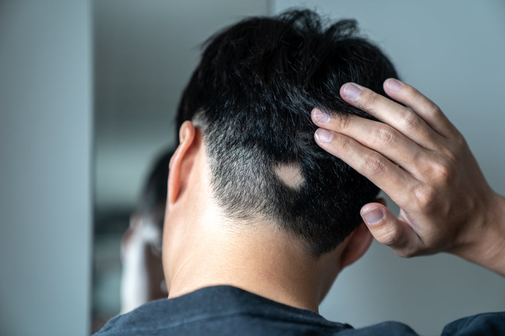 Les origines de la pelade chez l’homme