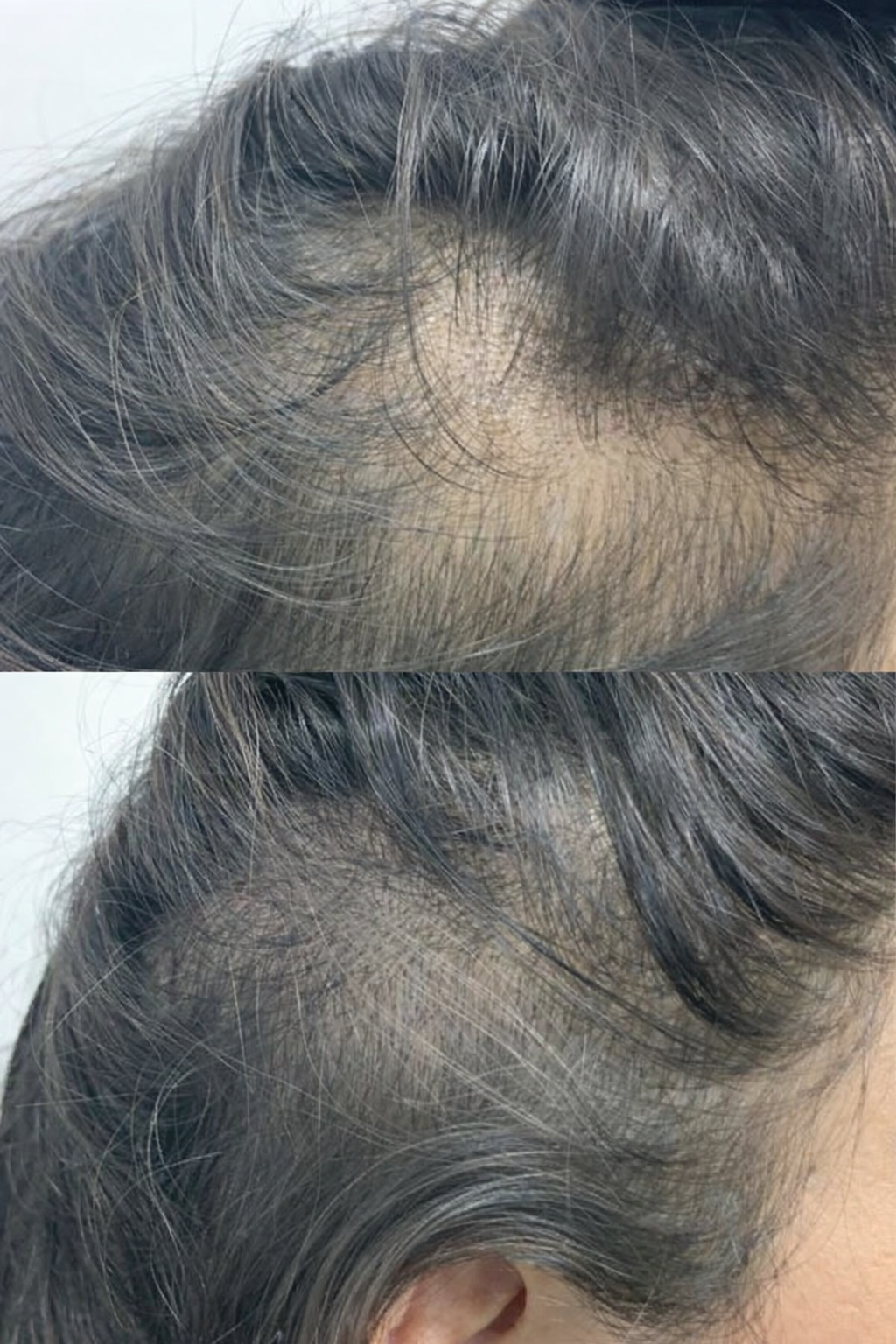 Tricopigmentation capillaire féminine à Marseille