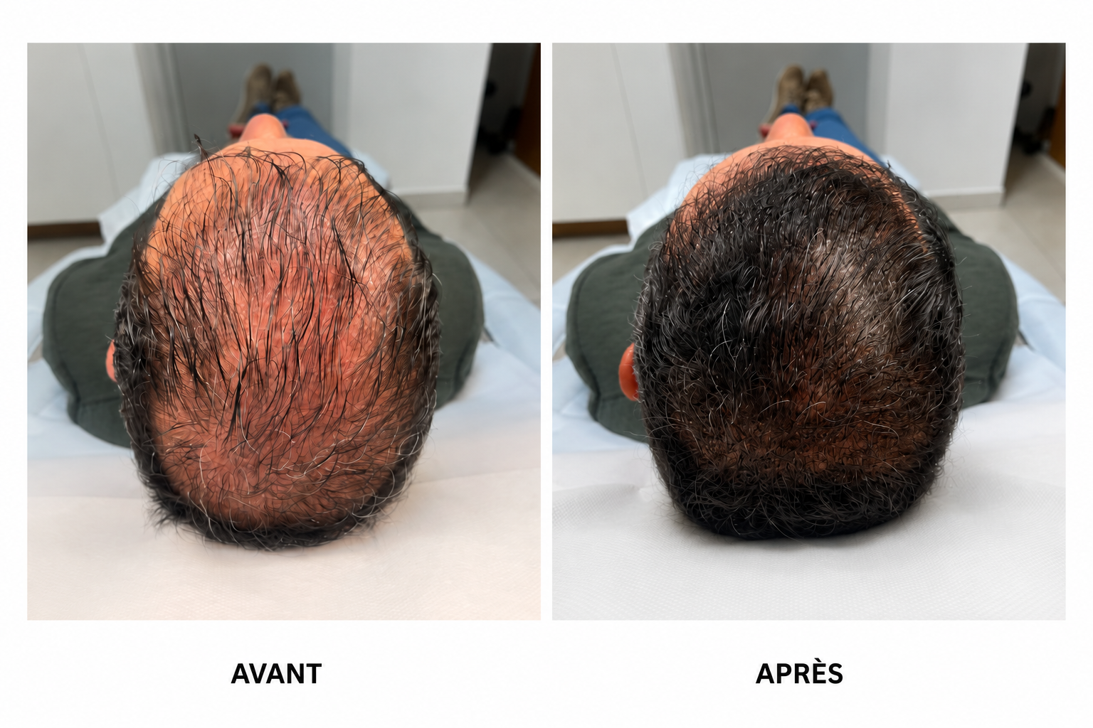 DERMA TREATMENT - TRICOPIGMENTATION MARSEILLE